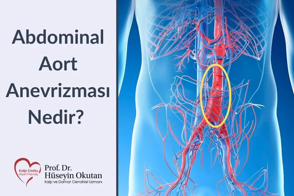 Abdominal Aort Anevrizması Nedir?