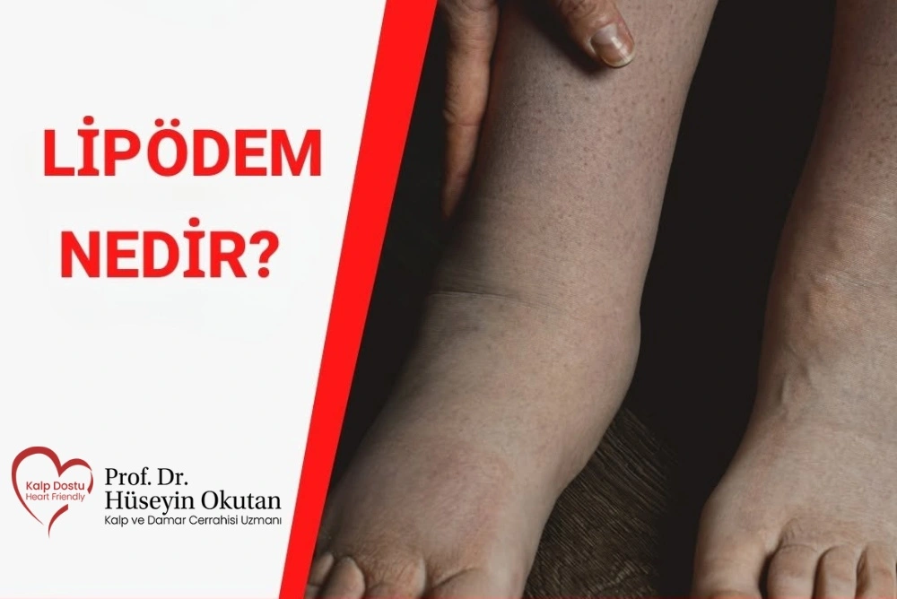 Lipödem (Ağrılı Selülit) Nedir? Ameliyatsız Lipödem Tedavisi