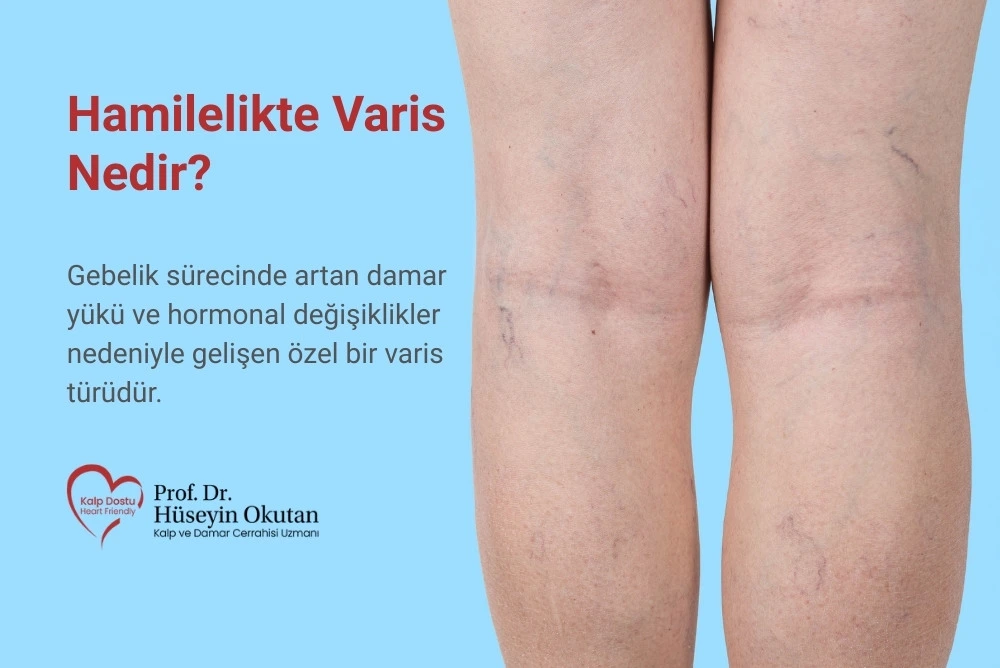 Hamilelikte Varis Nedir? Nedenleri, Belirtileri, Tedavisi