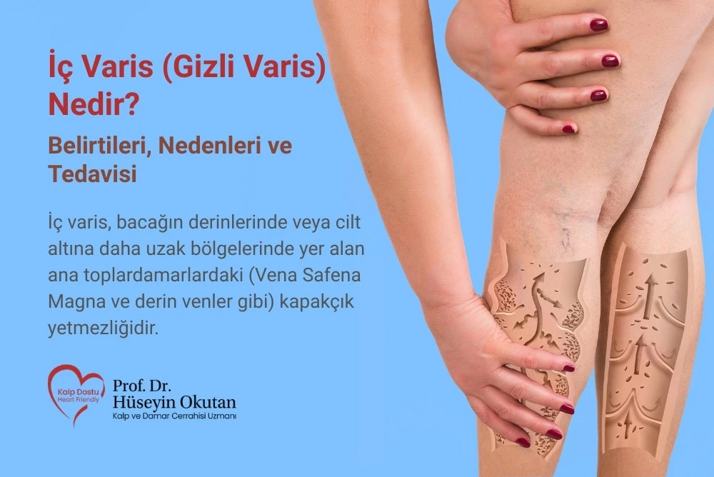 İç Varis (Gizli Varis) Nedir? İç Varis (Gizli Varis) Nedir? Belirtileri ve Ameliyatsız Tedavisi Antalya