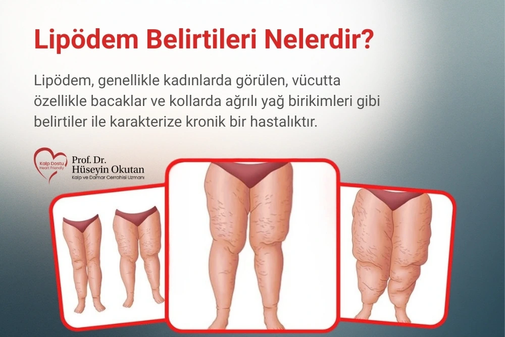 Lipödem Belirtileri Nelerdir? Nasıl Anlaşılır? Lipödem Belirtileri Nelerdir? Nasıl Anlaşılır? Antalya