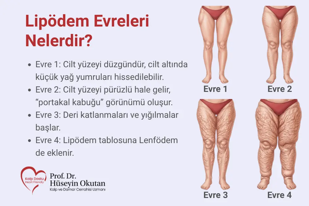 Lipödem Evreleri Nelerdir? Evrelerin Özellikleri ve Farkları | Prof. Dr. Hüseyin Okutan